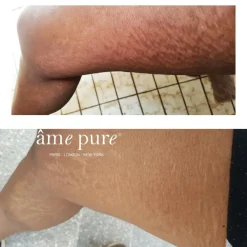 âme pure Body Basic - Stretch Marks<Børn Hudpleje Til Gravid Og Nybagt Mor|Hudpleje Til Gravid Og Nybagt Mor